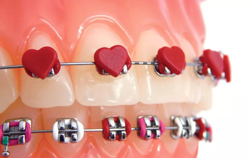 ortodonti dis tedavisi yildirim buras