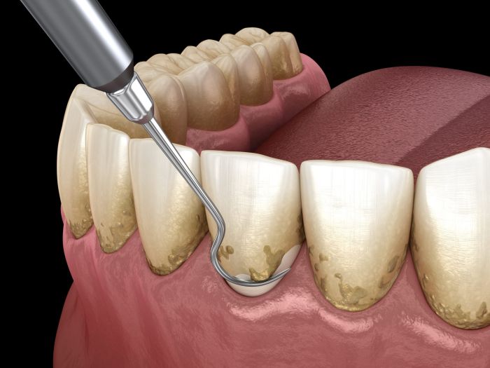 Diş Taşı Temizliği Neden Yaptırılmalı