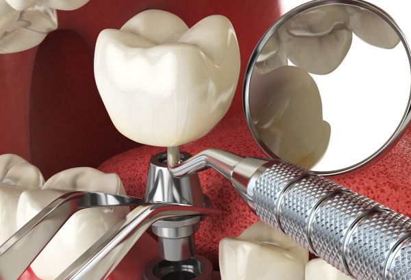 Bursa Diş İmplant Fiyatları 2023 6 Bursa Dis Implant Fiyatlari 2023