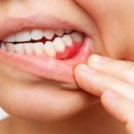 Diş Eti Çekilmesi Nedir
