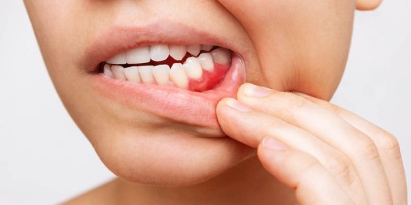 Diş Eti Çekilmesi Nedir? 2 Diş Eti Çekilmesi Nedir