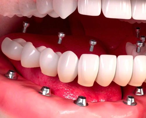 Dental Implants in Bursa 8 dental implants in bursa dent on6