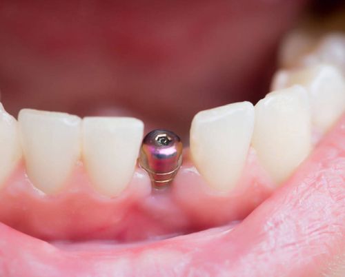 İmplantlı Diş 2 implantli diş dent on6