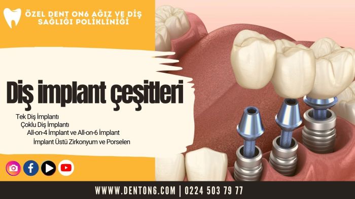 Diş İmplant Çeşitleri DENT ON6