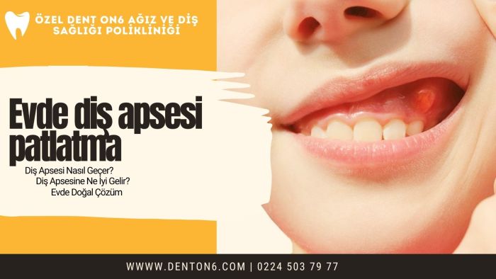 Evde diş apsesi patlatmaEvde diş apsesi patlatma DENT ON6 Yıldırım Bursa Diş