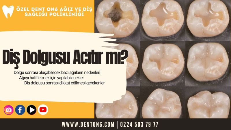 Diş Dolgusu Acıtır mı