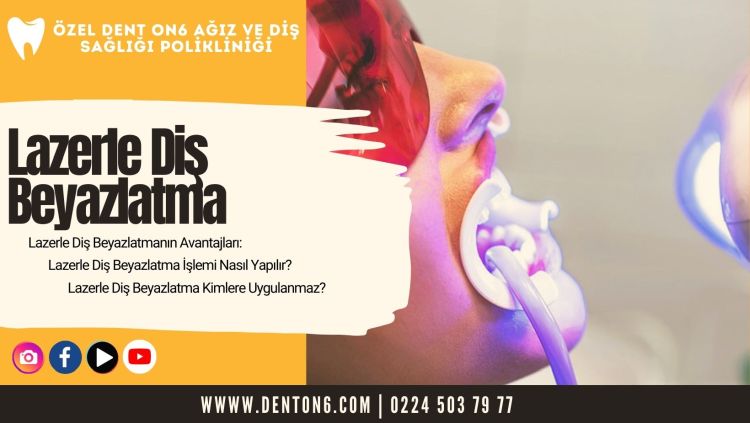 Lazerle Diş Beyazlatma 5 Lazerle Dis Beyazlatma DENT ON6 Bursa 1