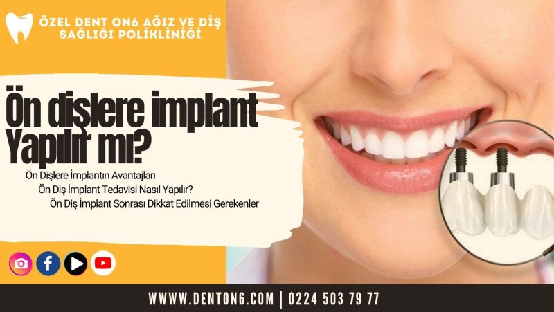 Ön dişlere implant Yapılır mı