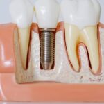 Megagen Implant iyi Mi 10eea79285f4a6c35d29041f8a745753