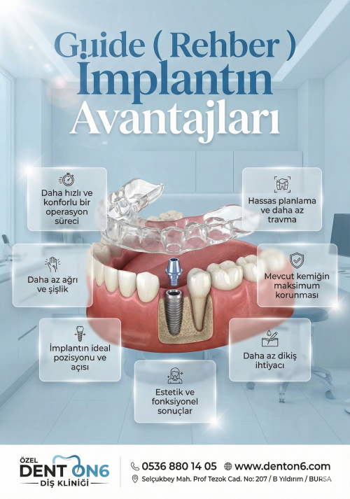Guide rehber implant dent on6