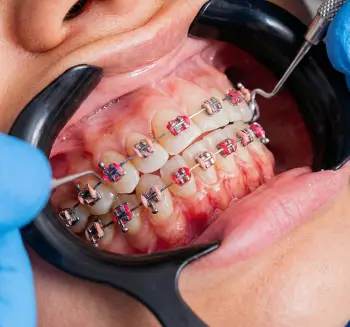 Ortodonti - Invisalign