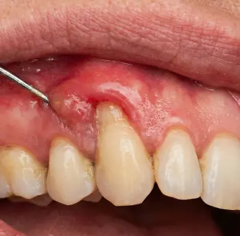 Bursa Yıldırım Diş Eti Hastalıkları