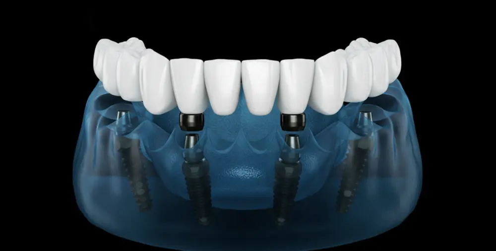 Yazılar Bursa’da All-on-4 ve All-on-6 İmplant Rehberi