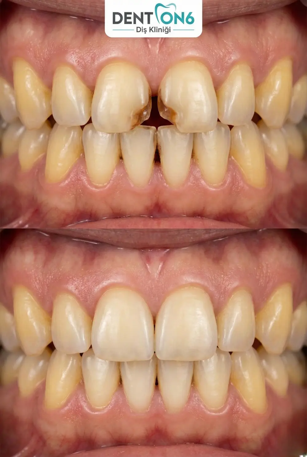 Aesthetic Composite Filling