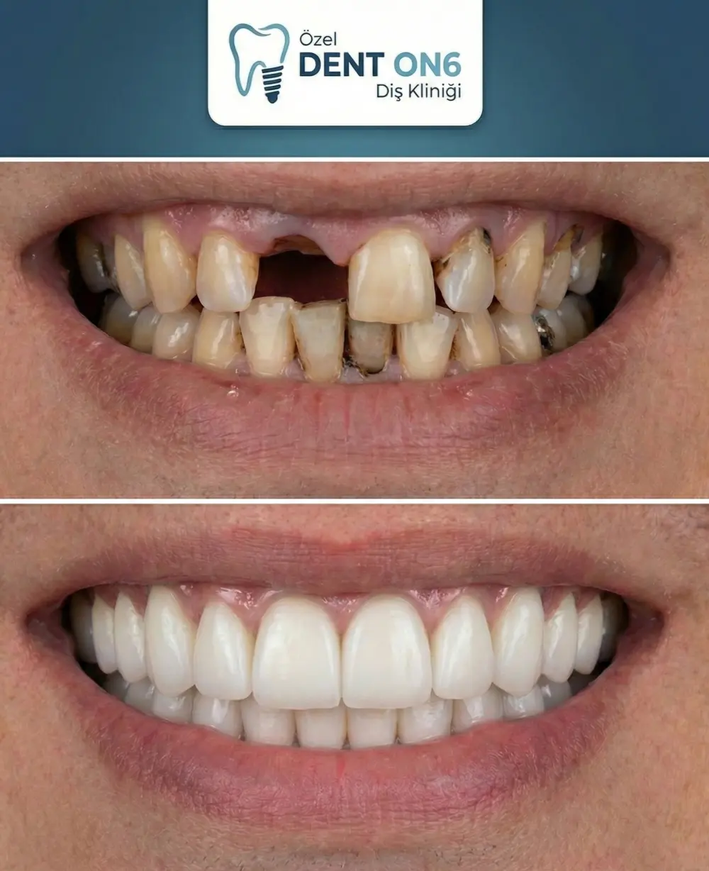 Zirconium + Dental Implant