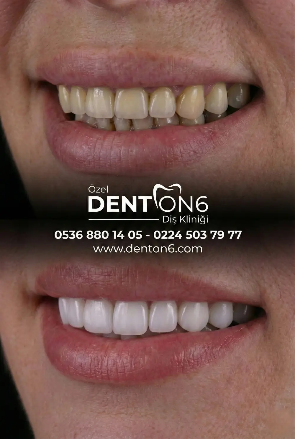 Bursa Yıldırım Zirkonyum Diş