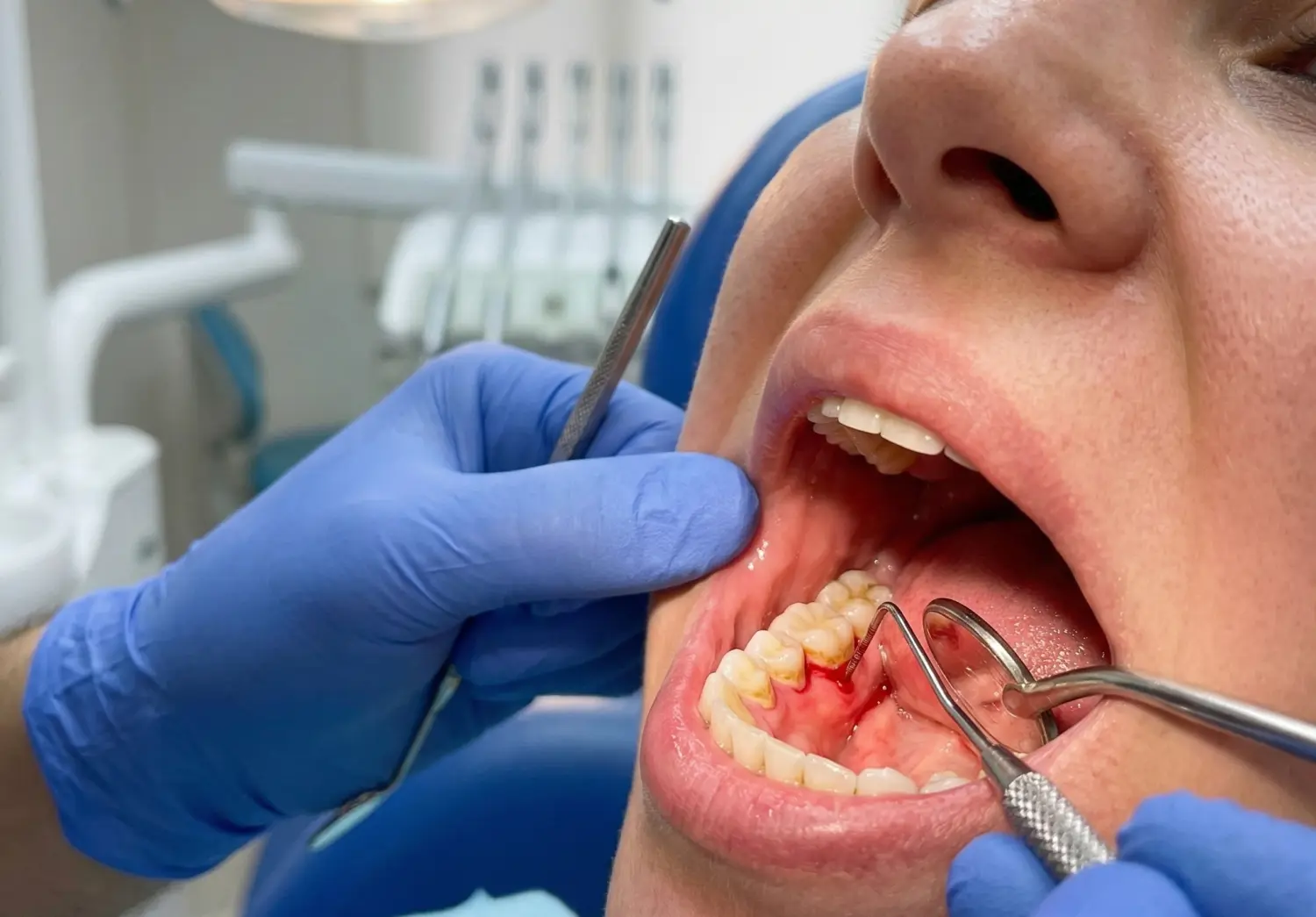 Diş eti şişmesi gösteren klinik fotoğraf