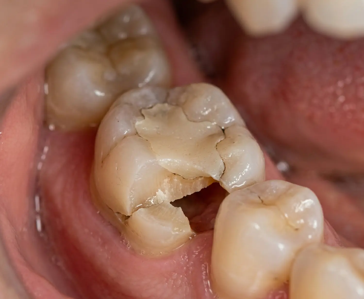 Dolgu olan dişimin kenarı kırıldı — nedenleri