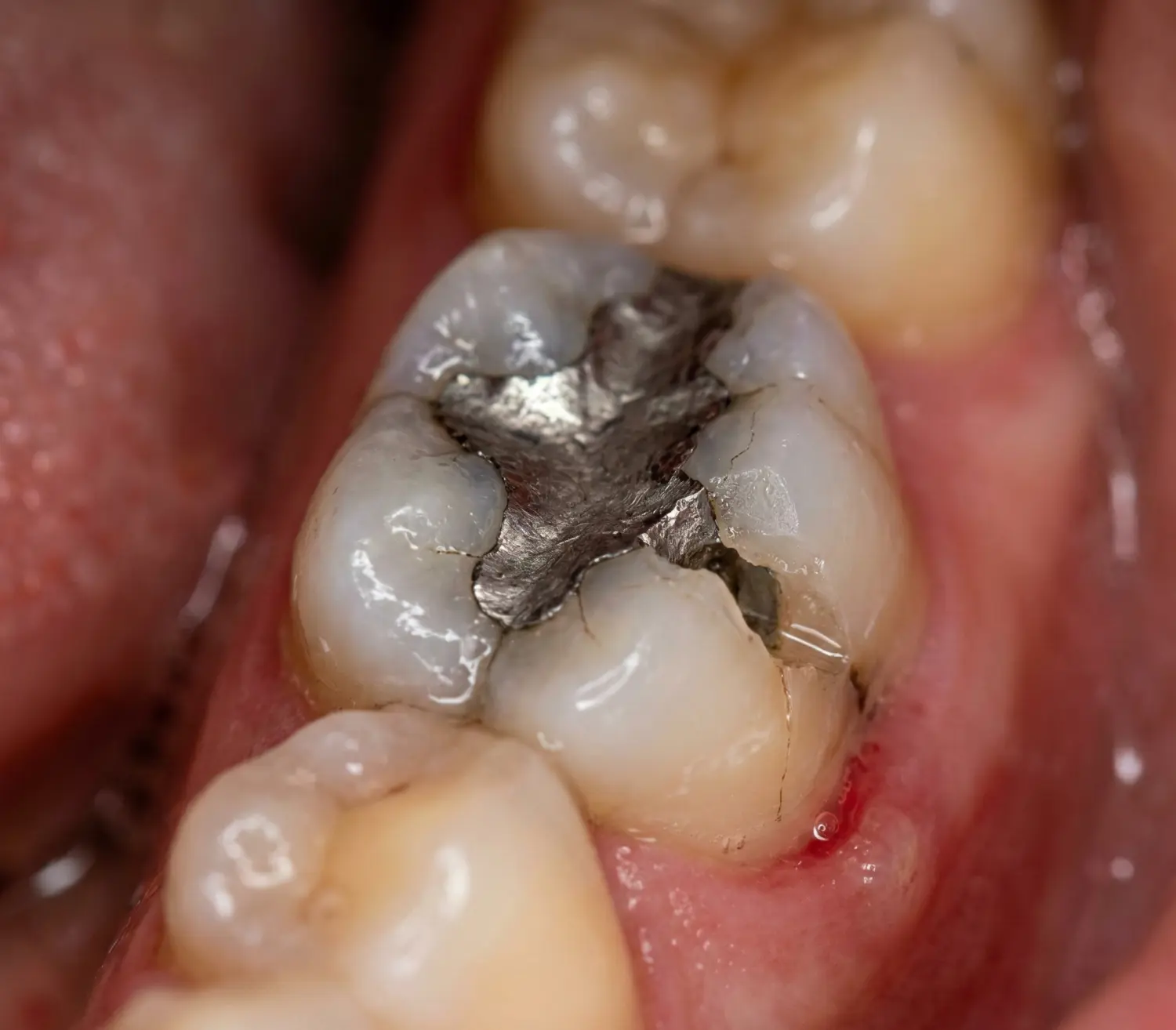 Dolgu olan dişin kenarı kırıldı — zirkonyum kaplama ve implant tedavi seçenekleri