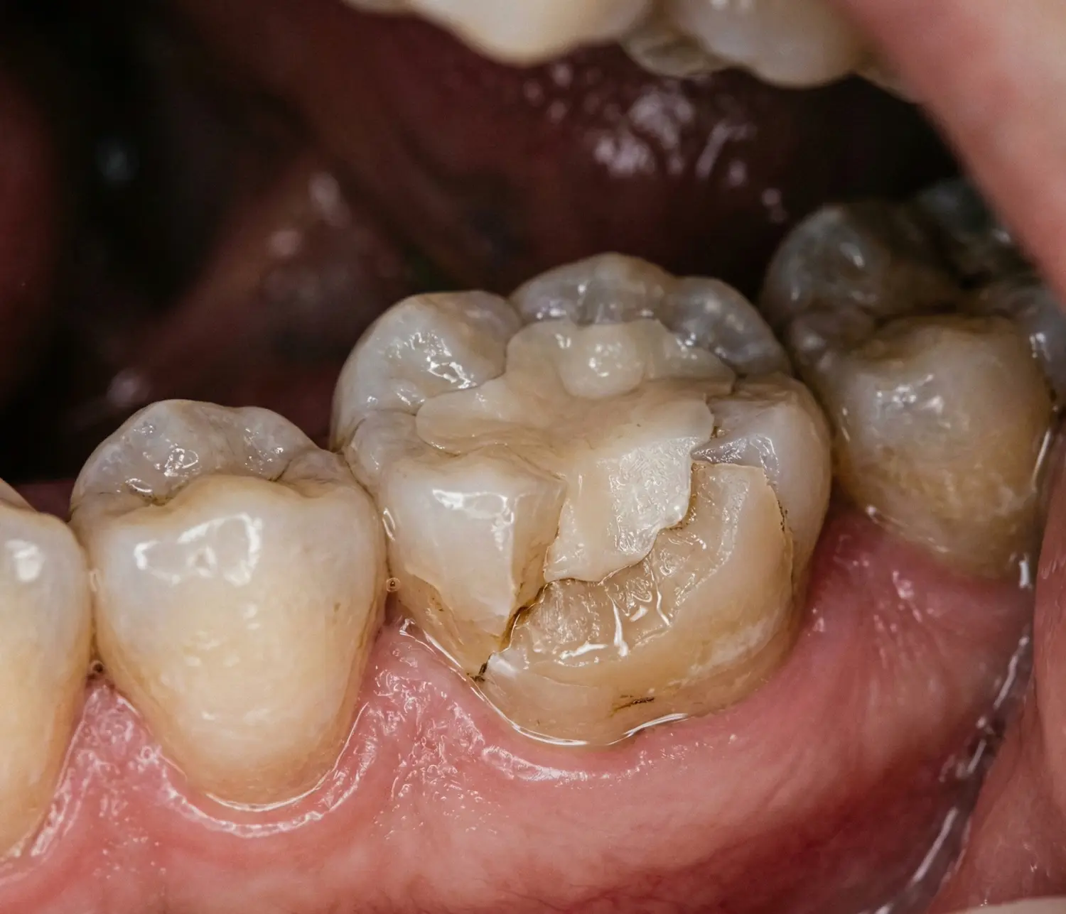 Dolgu olan dişin kenarı kırıldı — yapılması gerekenler